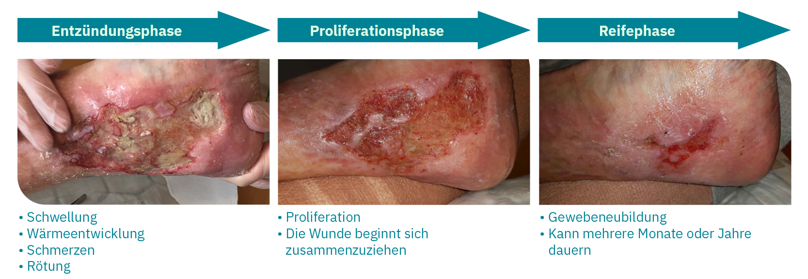 Ulcus Rodems Ulcus cruris behandeln: Ursachen, Symptome und wirksame Therapie