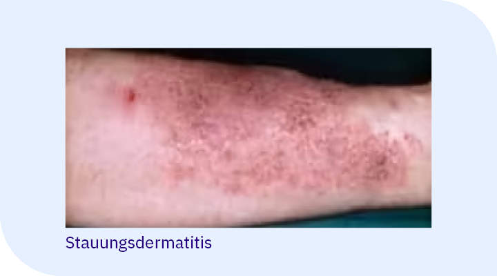 Venöses Unterschenkelgeschwür mit Stauungsdermatitis: gerötete, schuppige Haut und Ekzemveränderungen rund um ein venöses Beinulcus.