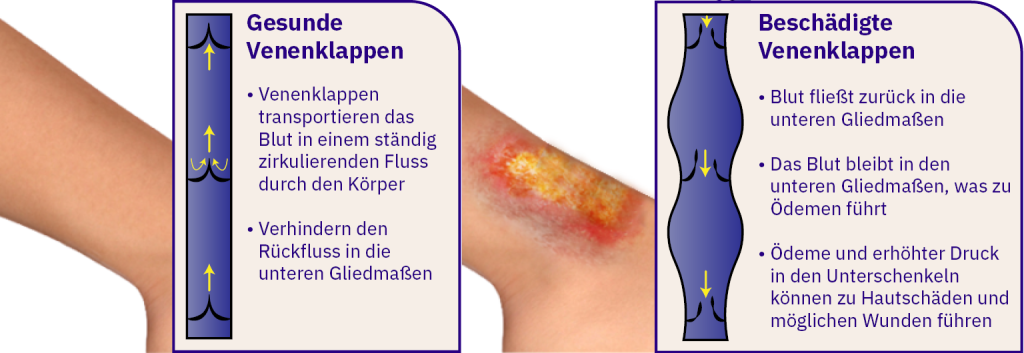 Venosen insuffizienz beschadigt venenklappen.