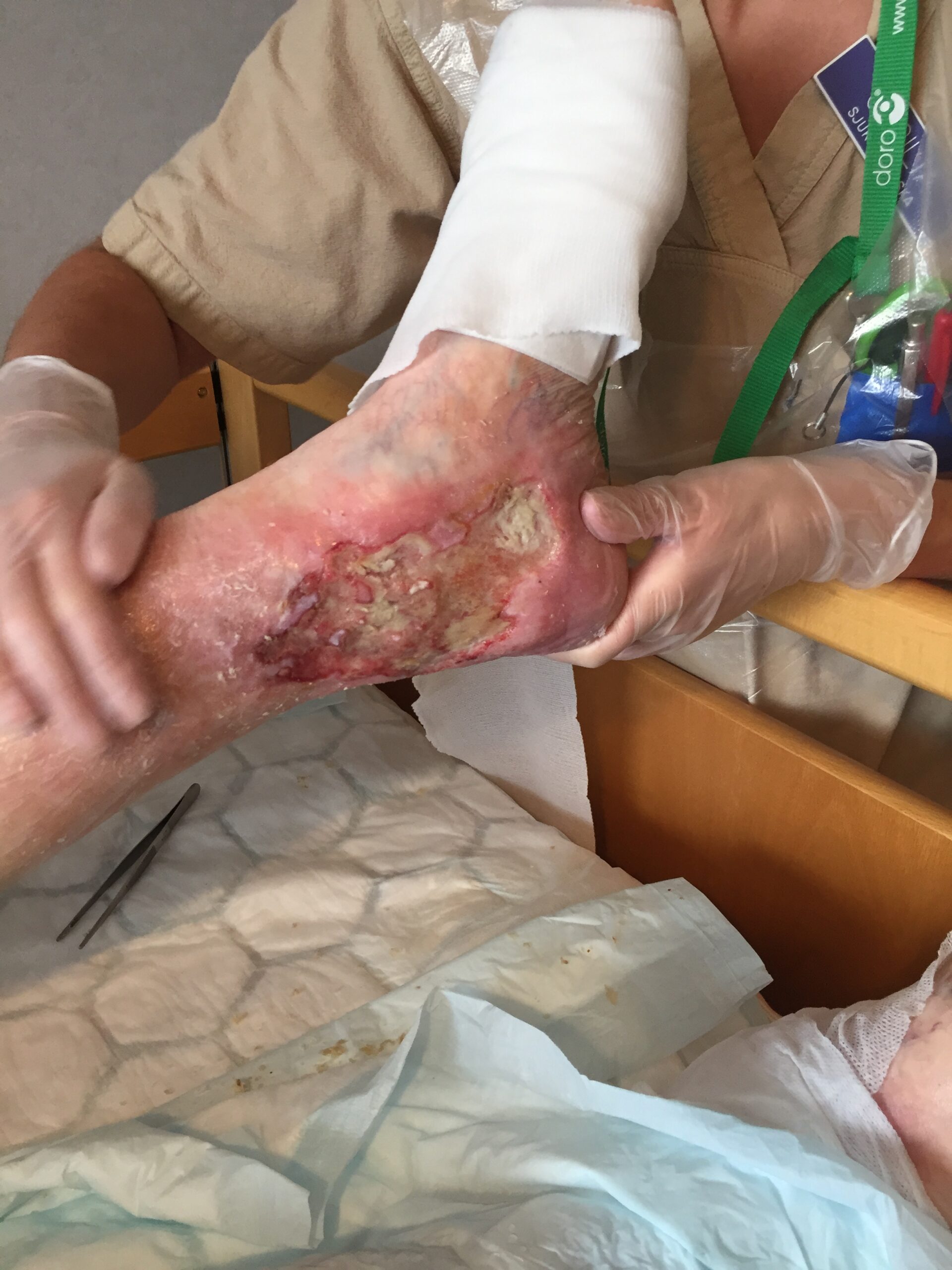 Picture of an leg ulcer