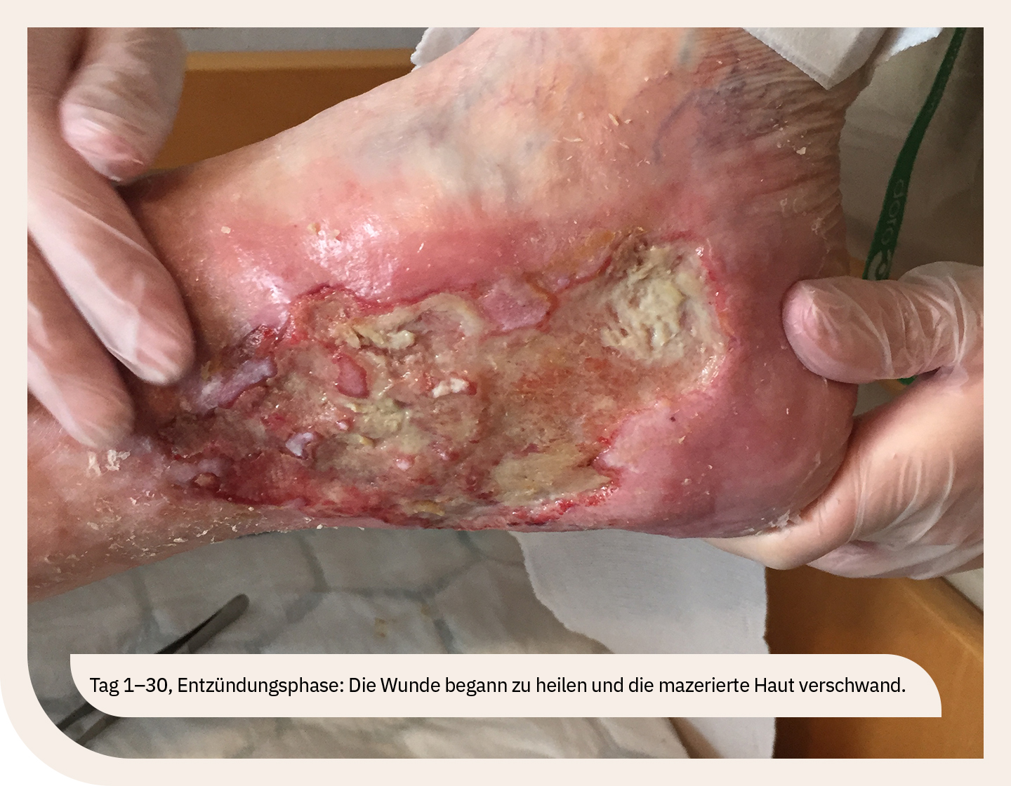 Abbildung einer Wunde in der Entzündungsphase, Wundbehandlung.