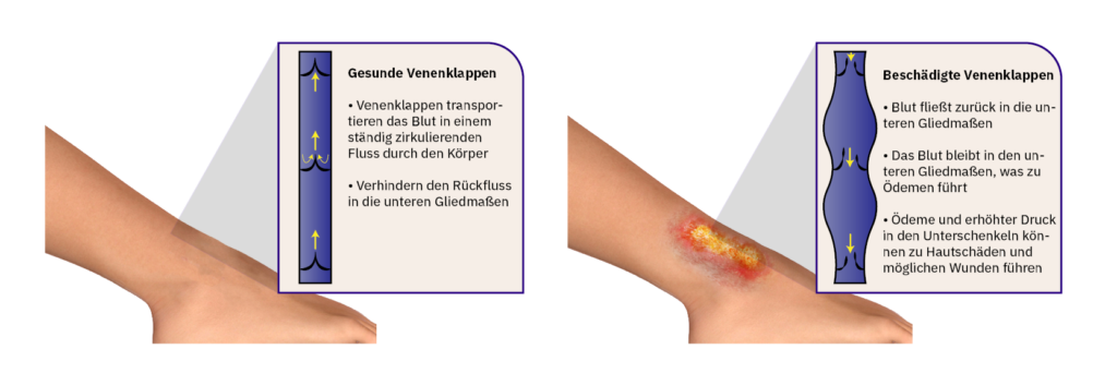 Eine Darstellung der venösen Insuffizienz und der Schäden an den Venenklappen