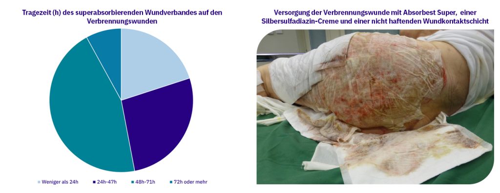 Versorgung der Verbrennungswunde mit Absorbest Super